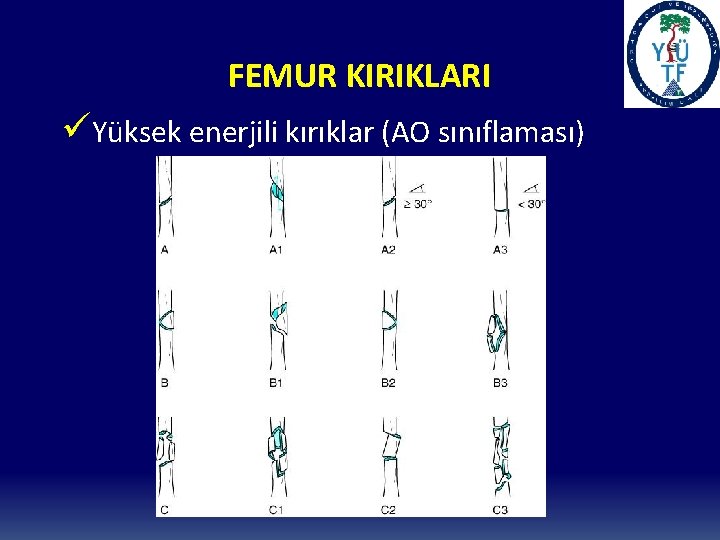 FEMUR KIRIKLARI üYüksek enerjili kırıklar (AO sınıflaması) 