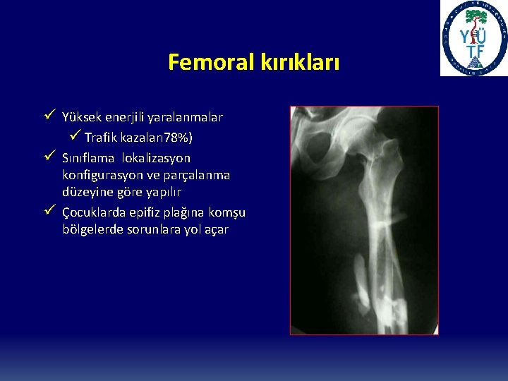 Femoral kırıkları ü Yüksek enerjili yaralanmalar ü Trafik kazaları 78%) ü Sınıflama lokalizasyon ü