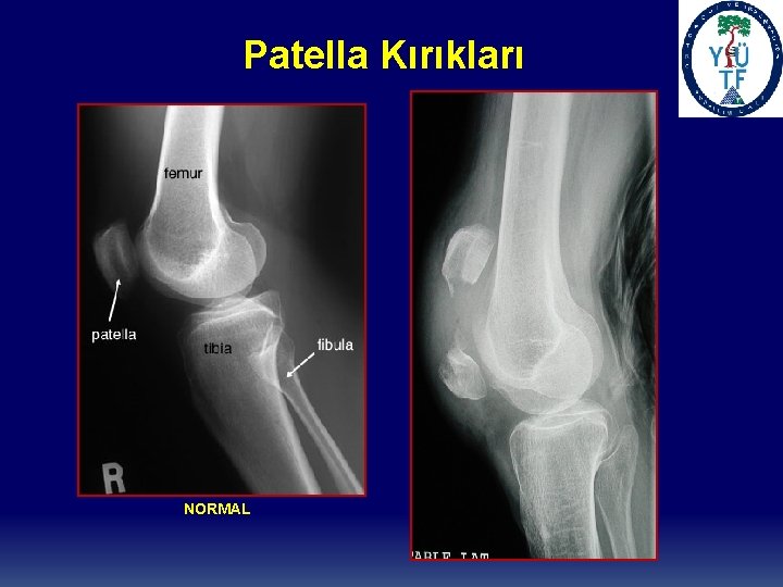 Patella Kırıkları NORMAL 