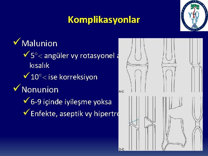 Komplikasyonlar üMalunion ü 5 angüler vy rotasyonel açılanma, 1 cm den fazla kısalık ü