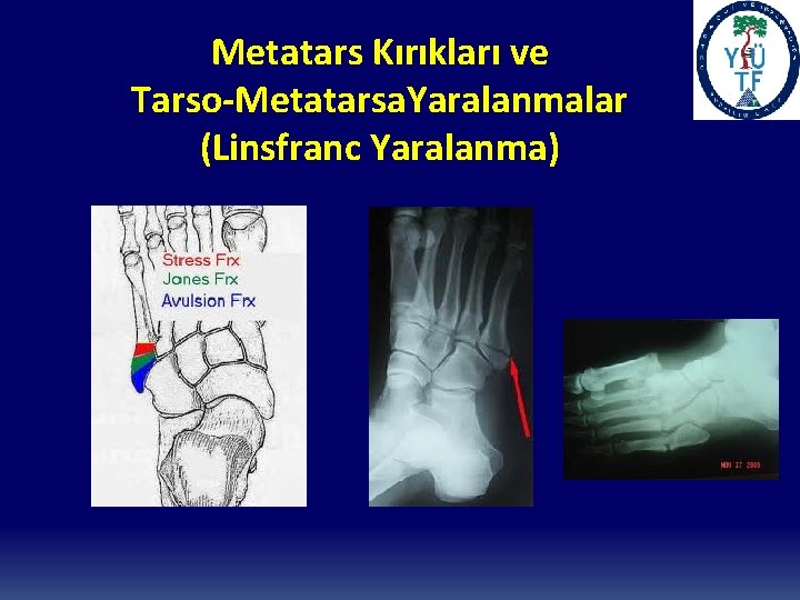 Metatars Kırıkları ve Tarso-Metatarsa. Yaralanmalar (Linsfranc Yaralanma) 