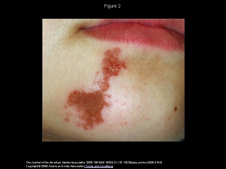 Figure 2 The Journal of the American Dental Association 2008 1391625 -1630 DOI: (10.