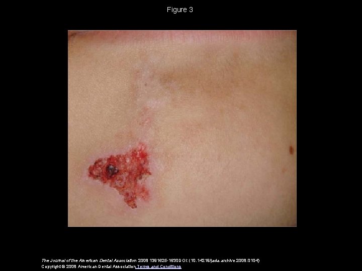 Figure 3 The Journal of the American Dental Association 2008 1391625 -1630 DOI: (10.