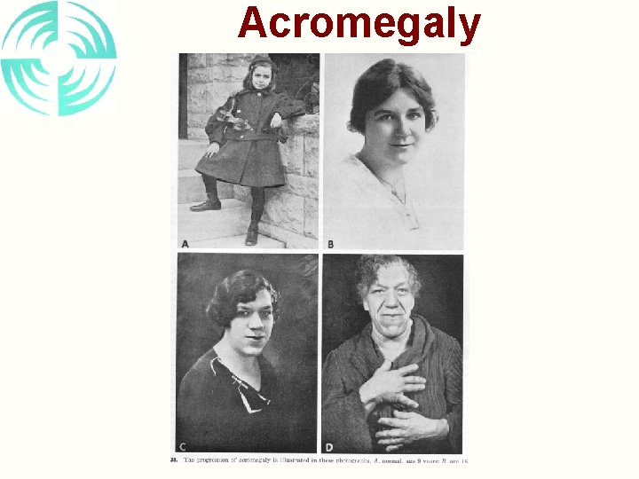 Acromegaly 