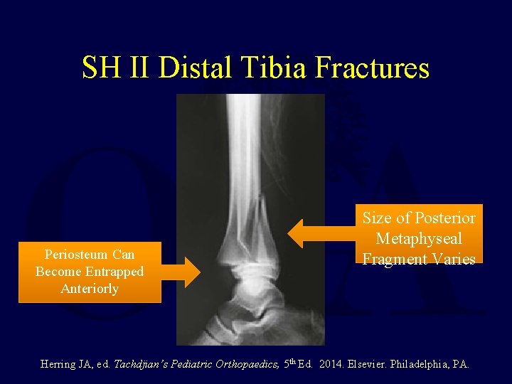 SH II Distal Tibia Fractures Periosteum Can Become Entrapped Anteriorly Size of Posterior Metaphyseal