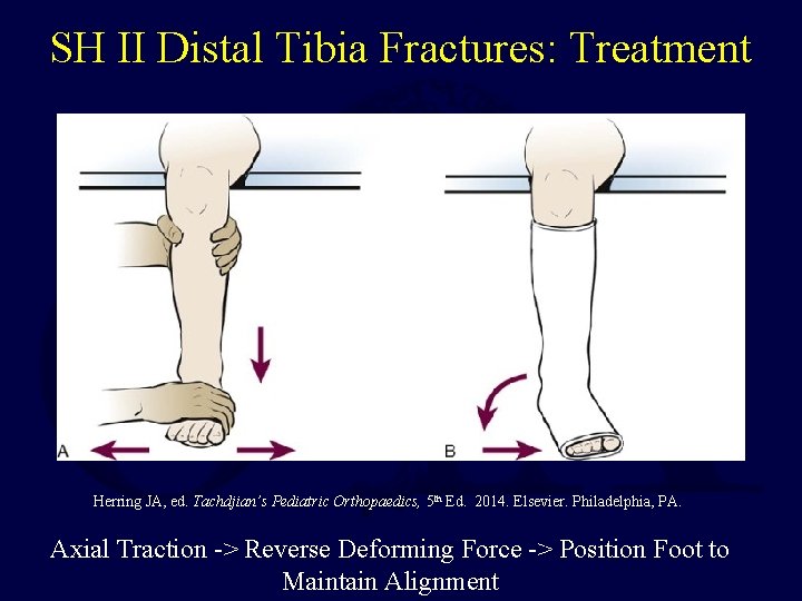 SH II Distal Tibia Fractures: Treatment Herring JA, ed. Tachdjian’s Pediatric Orthopaedics, 5 th