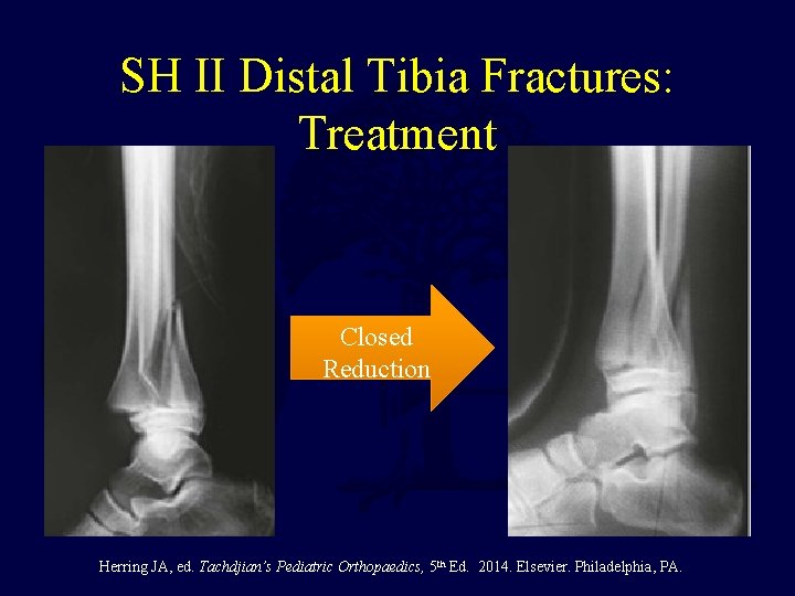SH II Distal Tibia Fractures: Treatment Closed Reduction Herring JA, ed. Tachdjian’s Pediatric Orthopaedics, SH II Distal Tibia Fractures: Treatment Closed Reduction Herring JA, ed. Tachdjian’s Pediatric Orthopaedics,