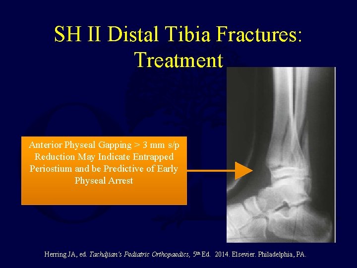 SH II Distal Tibia Fractures: Treatment Anterior Physeal Gapping > 3 mm s/p Reduction