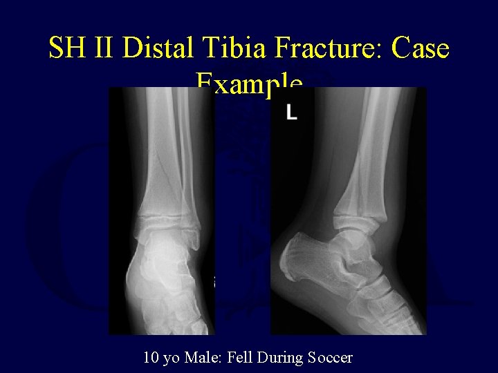 SH II Distal Tibia Fracture: Case Example 10 yo Male: Fell During Soccer 