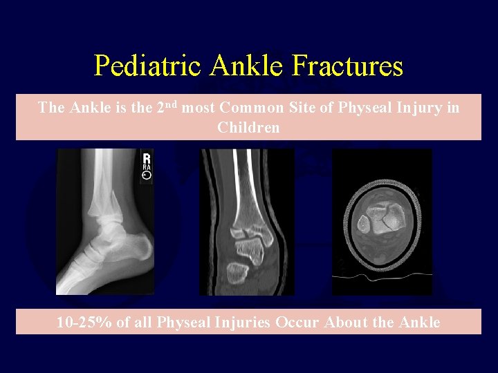 Pediatric Ankle Fractures The Ankle is the 2 nd most Common Site of Physeal