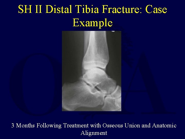 SH II Distal Tibia Fracture: Case Example 3 Months Following Treatment with Osseous Union SH II Distal Tibia Fracture: Case Example 3 Months Following Treatment with Osseous Union