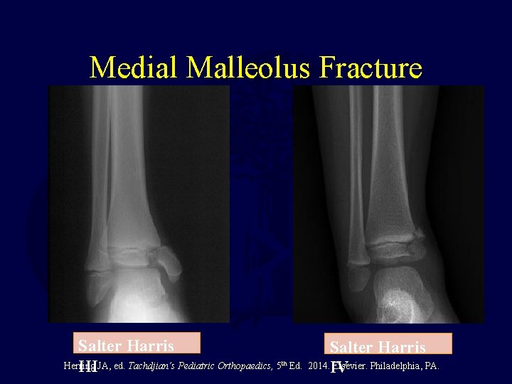 Medial Malleolus Fracture Salter Harris Herring IIIJA, ed. Tachdjian’s Pediatric Orthopaedics, 5 th Salter