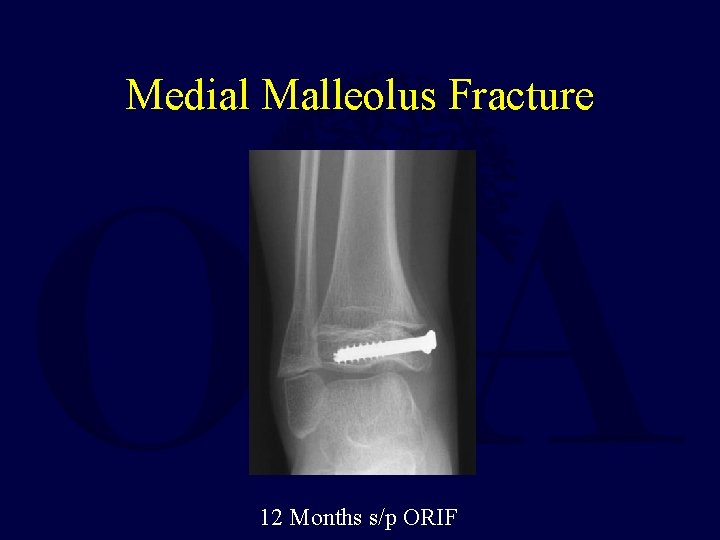 Medial Malleolus Fracture 12 Months s/p ORIF 