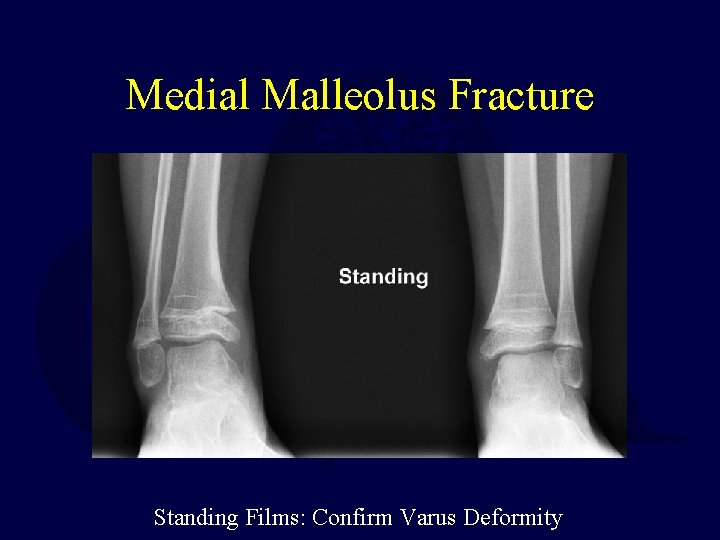 Medial Malleolus Fracture Standing Films: Confirm Varus Deformity 