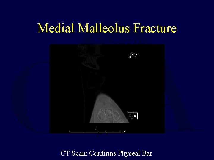 Medial Malleolus Fracture CT Scan: Confirms Physeal Bar 
