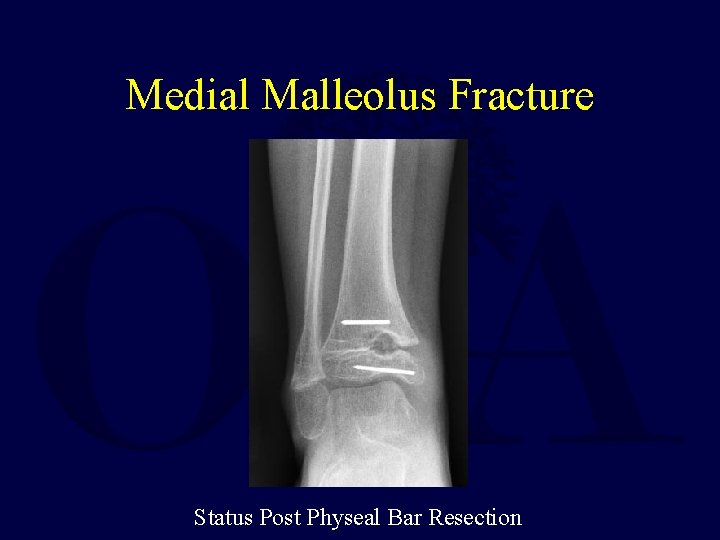 Medial Malleolus Fracture Status Post Physeal Bar Resection 