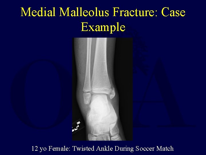 Medial Malleolus Fracture: Case Example 12 yo Female: Twisted Ankle During Soccer Match 