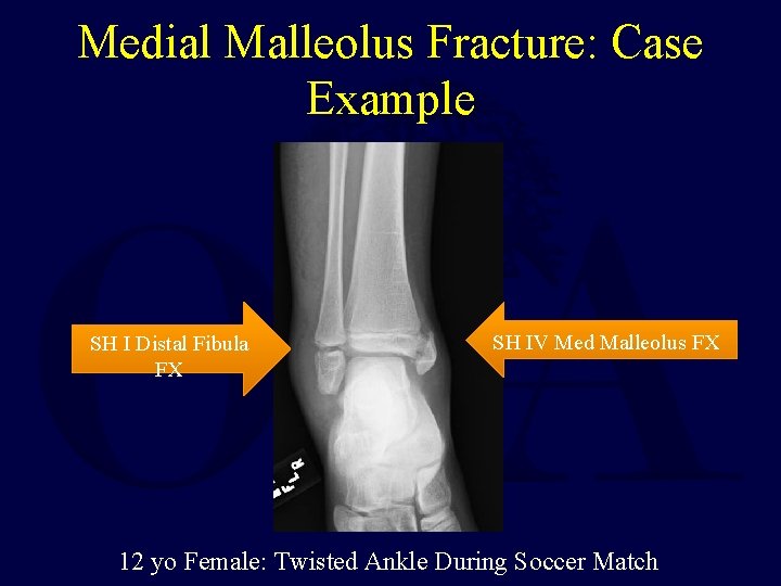 Medial Malleolus Fracture: Case Example SH I Distal Fibula FX SH IV Med Malleolus