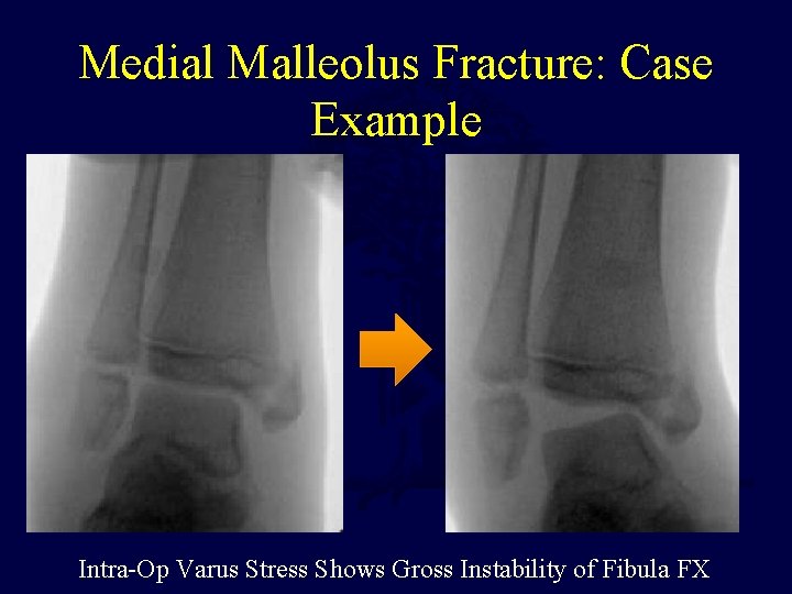 Medial Malleolus Fracture: Case Example Intra-Op Varus Stress Shows Gross Instability of Fibula FX