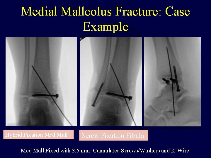 Medial Malleolus Fracture: Case Example Hybrid Fixation Med Mall Screw Fixation Fibula Med Mall