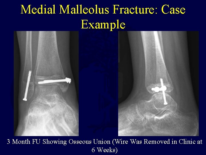 Medial Malleolus Fracture: Case Example 3 Month FU Showing Osseous Union (Wire Was Removed