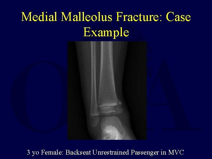 Medial Malleolus Fracture: Case Example 3 yo Female: Backseat Unrestrained Passenger in MVC 