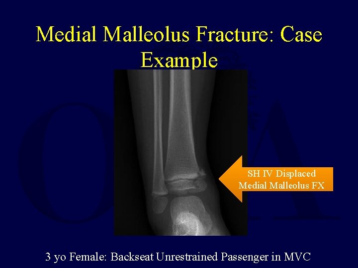 Medial Malleolus Fracture: Case Example SH IV Displaced Medial Malleolus FX 3 yo Female: