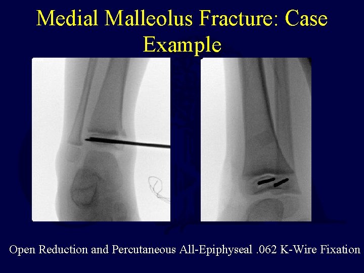 Medial Malleolus Fracture: Case Example Open Reduction and Percutaneous All-Epiphyseal. 062 K-Wire Fixation 