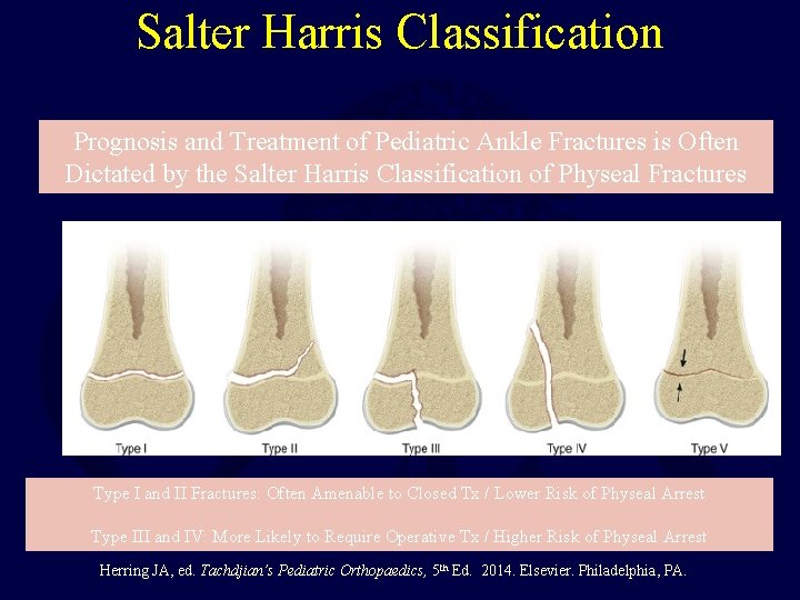 Salter Harris Classification Prognosis and Treatment of Pediatric Ankle Fractures is Often Dictated by