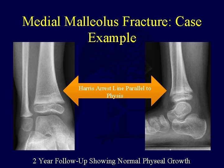 Medial Malleolus Fracture: Case Example Harris Arrest Line Parallel to Physis 2 Year Follow-Up