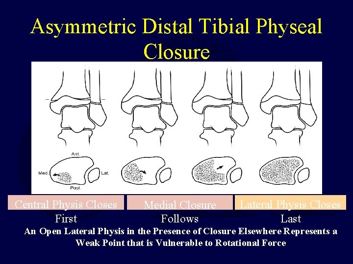 Asymmetric Distal Tibial Physeal Closure 12. 5 Yrs Central Physis Closes First 13 Yrs