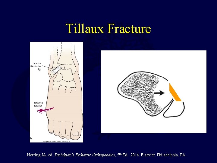 Tillaux Fracture Inf TFL Herring JA, ed. Tachdjian’s Pediatric Orthopaedics, 5 th Ed. 2014.