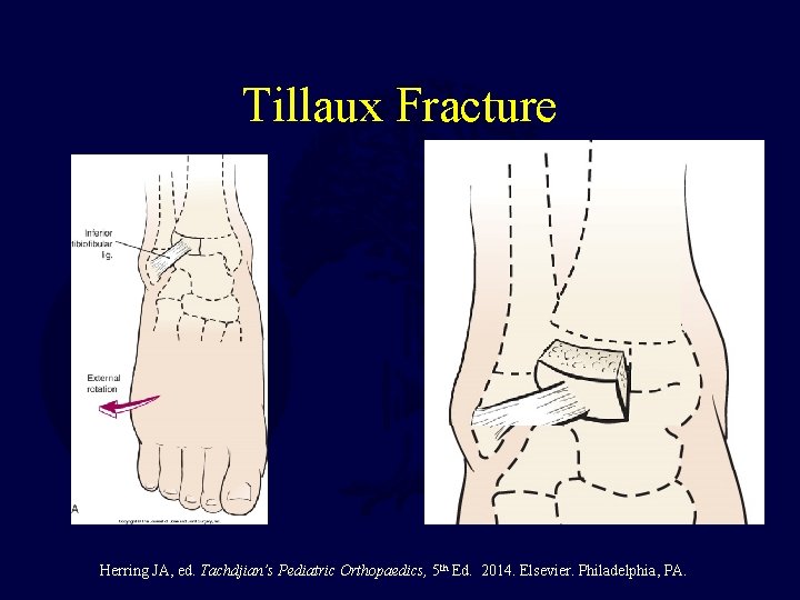 Tillaux Fracture Herring JA, ed. Tachdjian’s Pediatric Orthopaedics, 5 th Ed. 2014. Elsevier. Philadelphia,