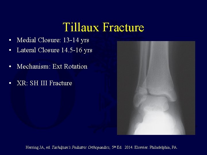 Tillaux Fracture • Medial Closure: 13 -14 yrs • Lateral Closure 14. 5 -16