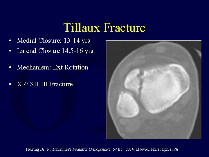Tillaux Fracture • Medial Closure: 13 -14 yrs • Lateral Closure 14. 5 -16 Tillaux Fracture • Medial Closure: 13 -14 yrs • Lateral Closure 14. 5 -16