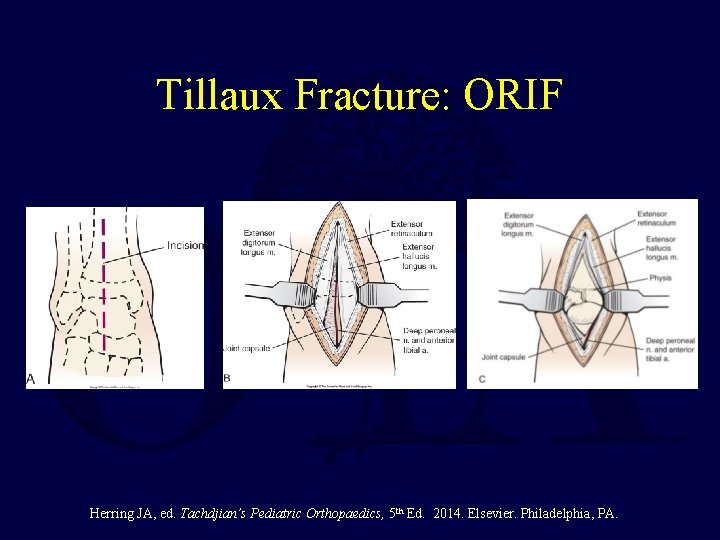 Tillaux Fracture: ORIF Herring JA, ed. Tachdjian’s Pediatric Orthopaedics, 5 th Ed. 2014. Elsevier.