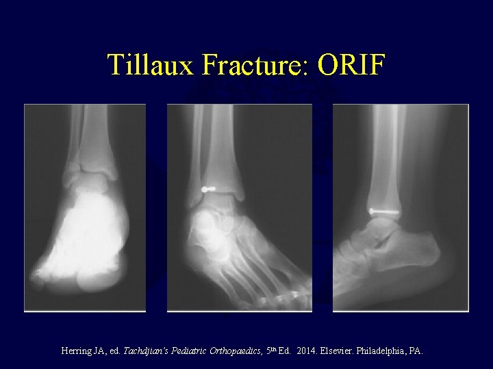 Tillaux Fracture: ORIF Herring JA, ed. Tachdjian’s Pediatric Orthopaedics, 5 th Ed. 2014. Elsevier.