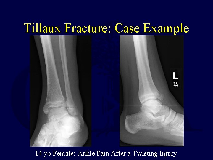 Tillaux Fracture: Case Example 14 yo Female: Ankle Pain After a Twisting Injury 