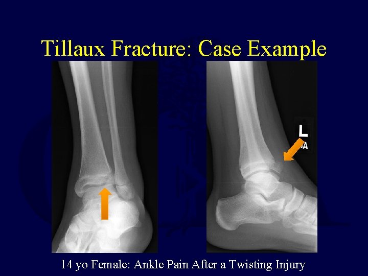 Tillaux Fracture: Case Example 14 yo Female: Ankle Pain After a Twisting Injury 