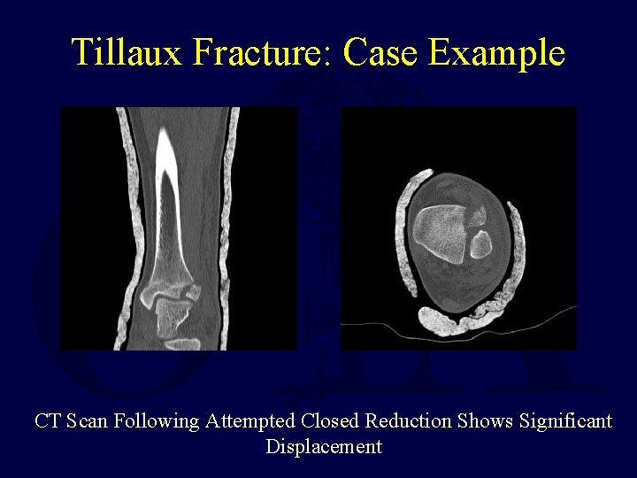 Tillaux Fracture: Case Example CT Scan Following Attempted Closed Reduction Shows Significant Displacement Tillaux Fracture: Case Example CT Scan Following Attempted Closed Reduction Shows Significant Displacement
