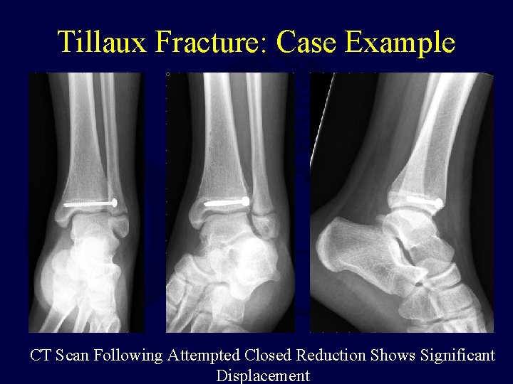 Tillaux Fracture: Case Example CT Scan Following Attempted Closed Reduction Shows Significant Displacement 