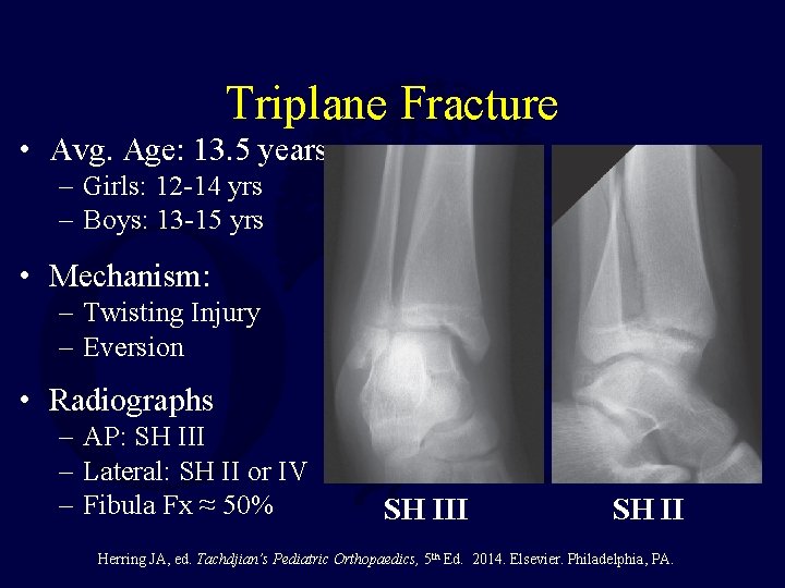 Triplane Fracture • Avg. Age: 13. 5 years – Girls: 12 -14 yrs –