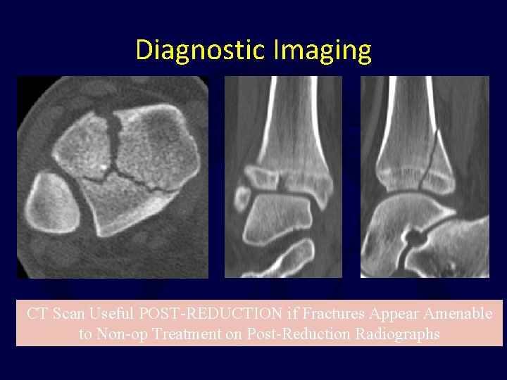 Diagnostic Imaging CT Scan Useful POST-REDUCTION if Fractures Appear Amenable to Non-op Treatment on