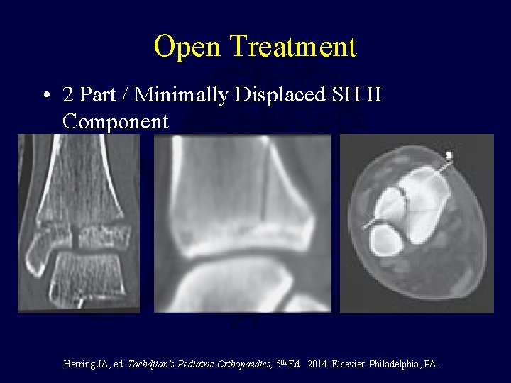 Open Treatment • 2 Part / Minimally Displaced SH II Component Herring JA, ed. Open Treatment • 2 Part / Minimally Displaced SH II Component Herring JA, ed.