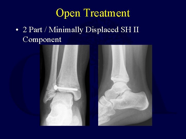 Open Treatment • 2 Part / Minimally Displaced SH II Component 