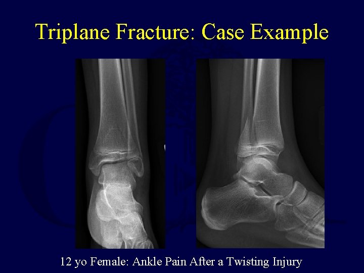 Triplane Fracture: Case Example 12 yo Female: Ankle Pain After a Twisting Injury 