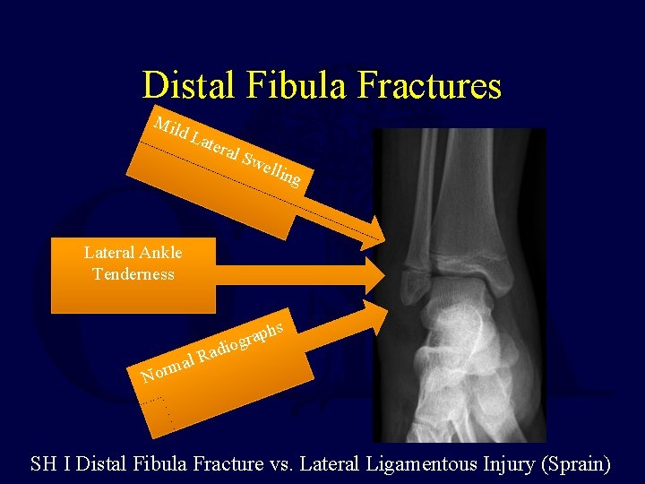 Distal Fibula Fractures Mil d. L ater al S w ellin g Lateral Ankle Distal Fibula Fractures Mil d. L ater al S w ellin g Lateral Ankle