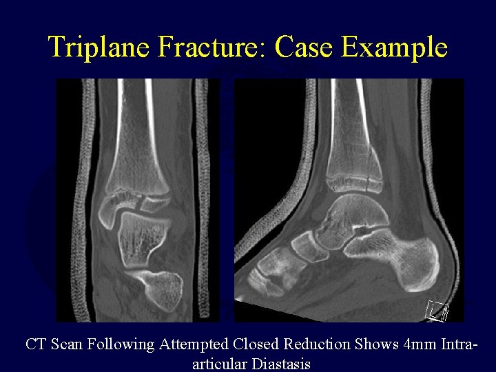 Triplane Fracture: Case Example CT Scan Following Attempted Closed Reduction Shows 4 mm Intraarticular