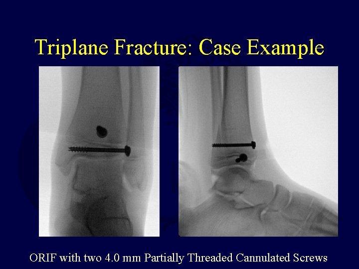Triplane Fracture: Case Example ORIF with two 4. 0 mm Partially Threaded Cannulated Screws