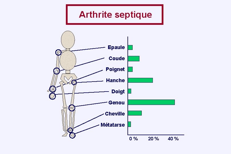 Arthrite septique Epaule Coude Poignet Hanche Doigt Genou Cheville Métatarse 0 % 20 %